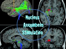 Nucleus Accumbens Stimulation